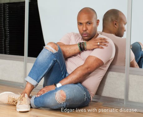Edgar lives with psoriatic disease.