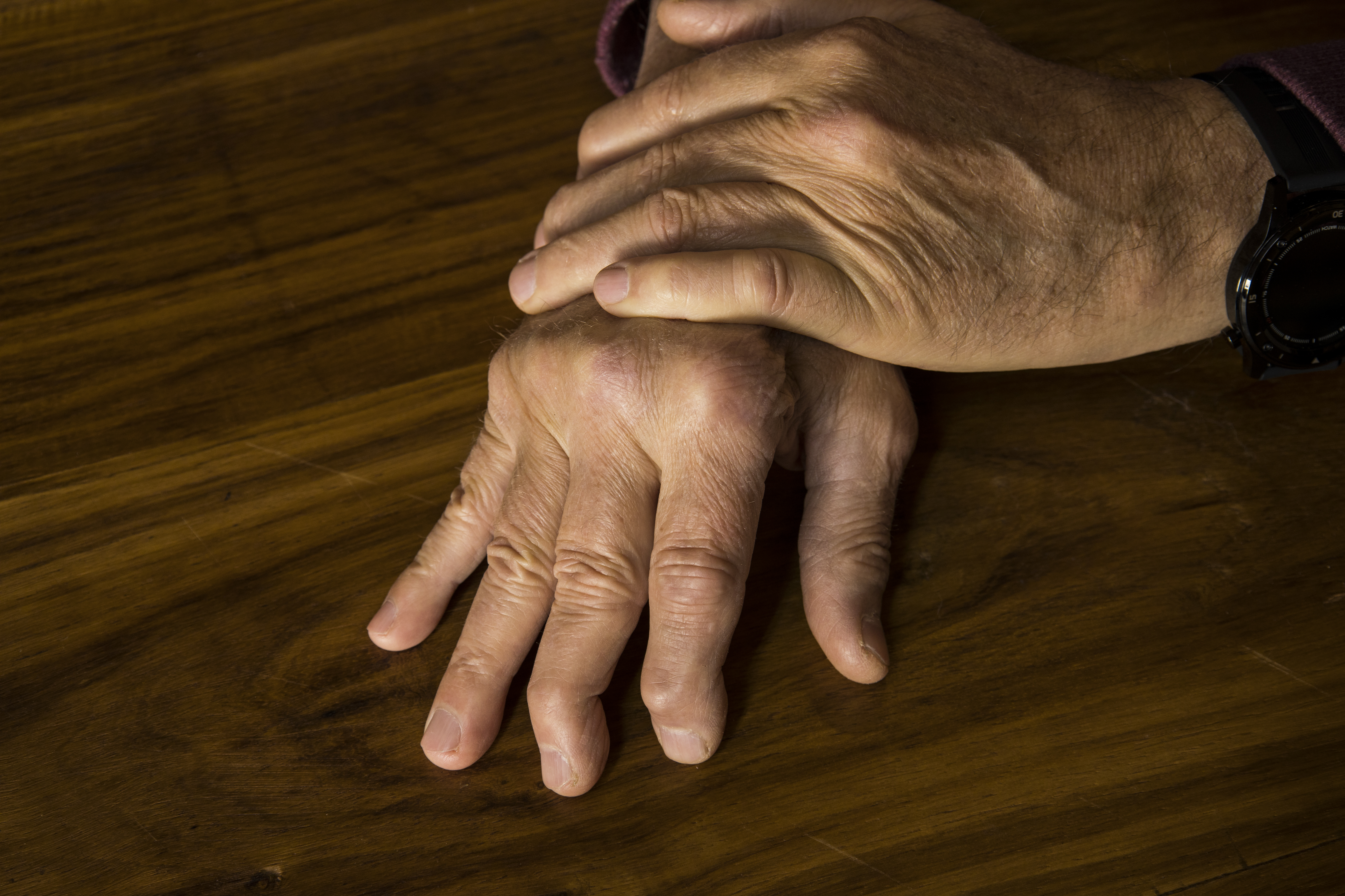 A person's hands show the effects of psoriatic arthritis.
