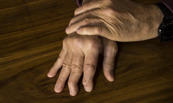 A persons hands show the effects of psoriatic arthritis.