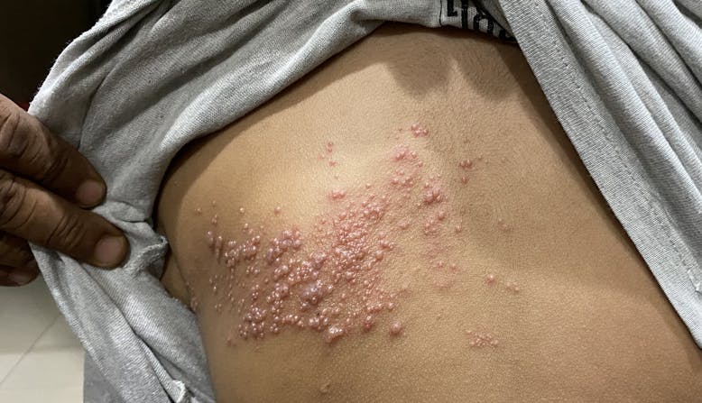 A person with shingles.
