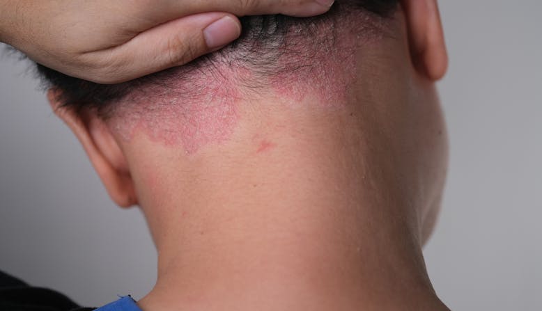 A young person shows their scalp psoriasis
