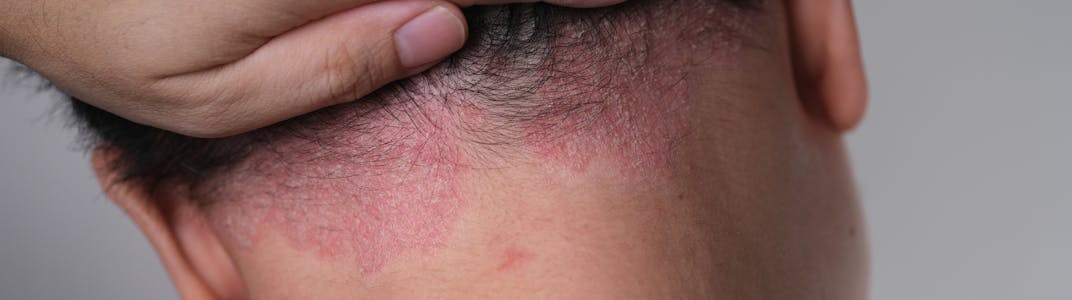 A young person shows their scalp psoriasis