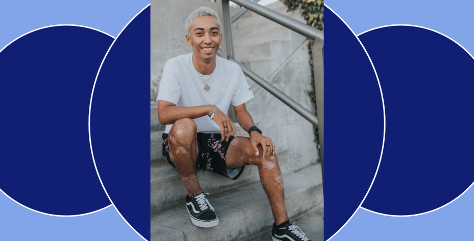 Matteo sits on steps outside with his psoriasis visible on his legs.