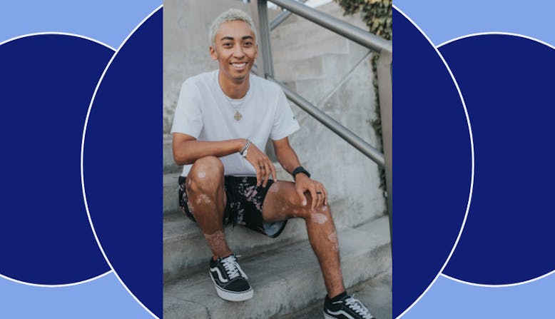 Matteo sits on steps outside with his psoriasis visible on his legs.