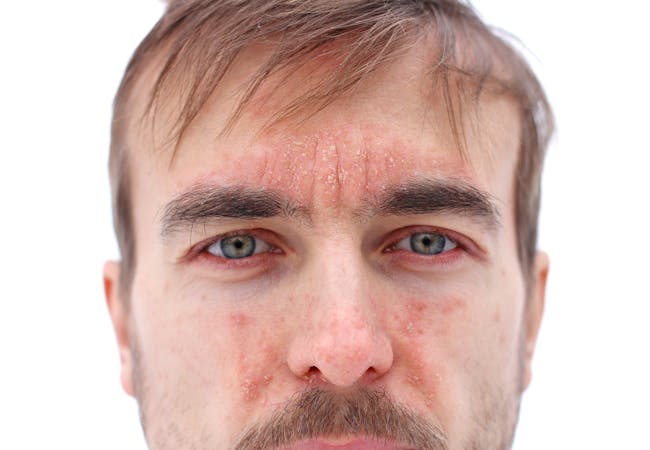 A man with psoriasis on his face including forehead, cheeks, and nose.