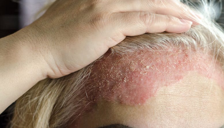 Scalp psoriasis on a woman's forehead.