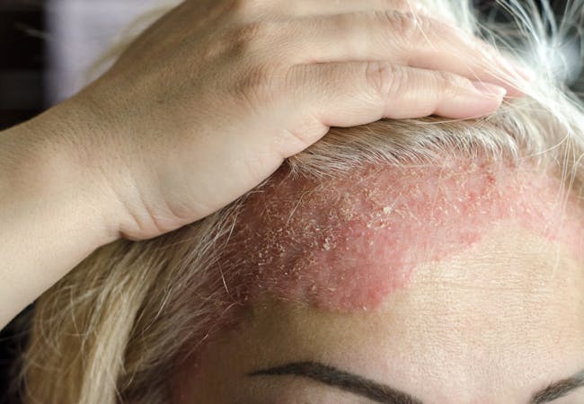 Scalp psoriasis on a woman's forehead.