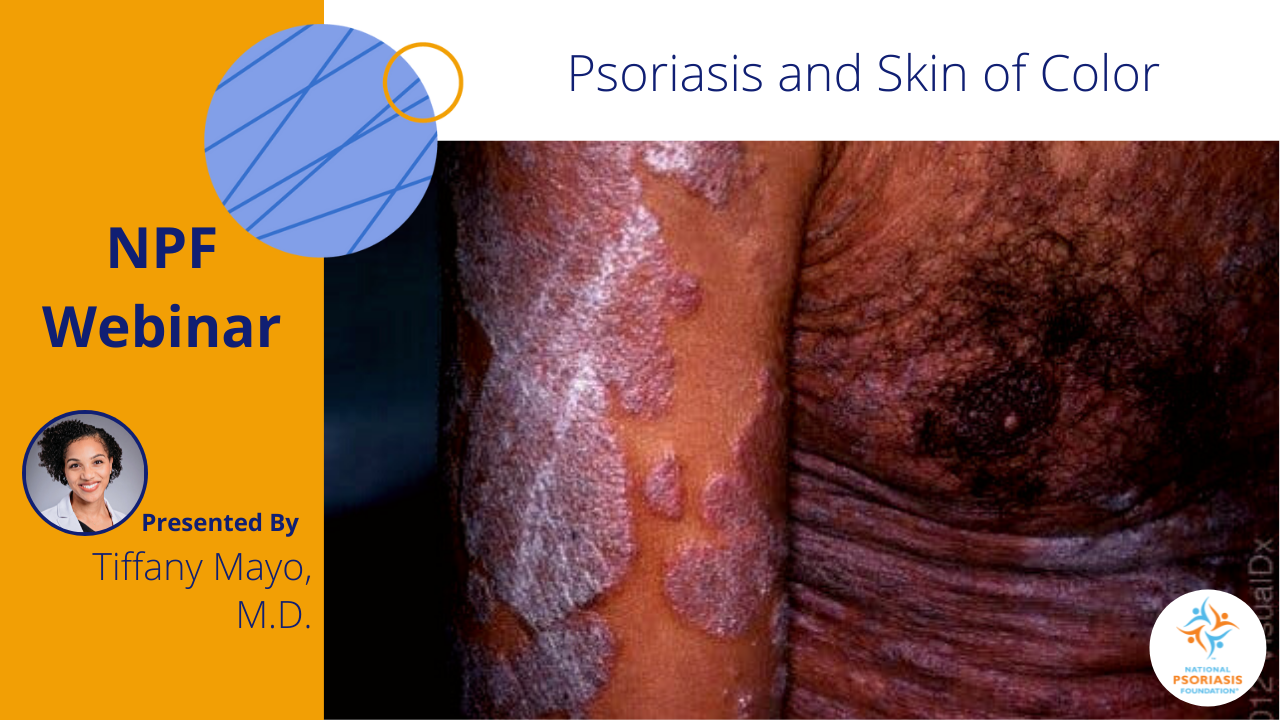 NPF Webinar: Psoriasis and Skin of Color. Presented by Tiffany Mayo, M.D.