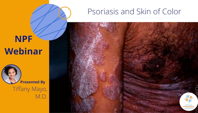 NPF Webinar: Psoriasis and Skin of Color. Presented by Tiffany Mayo, M.D.