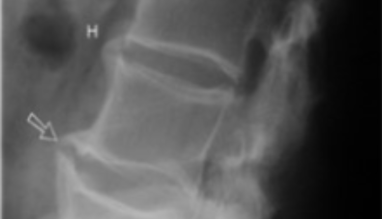 Spondylitis - a symptom of psoriatic arthritis