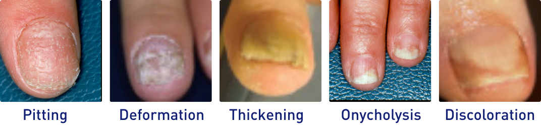 Nail psoriasis examples - pitting, deformation, thickening, onycholysis, discoloration