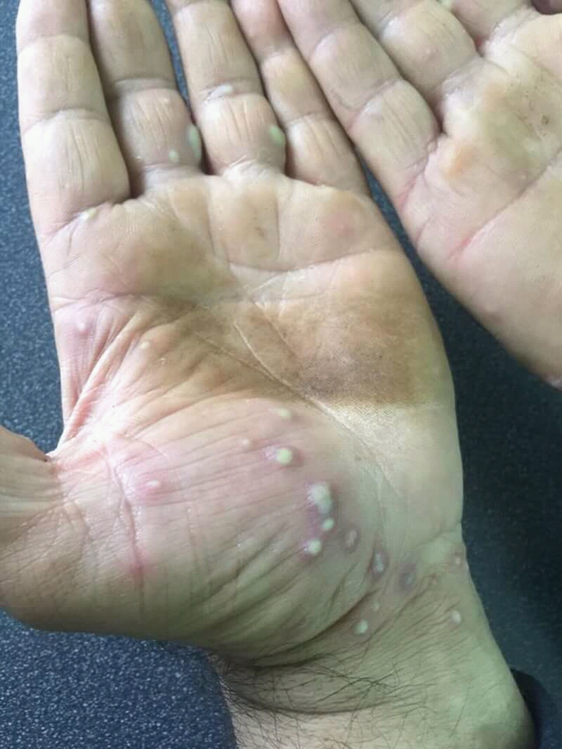 Psoriasis on hands