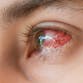 women with a red and watery eye