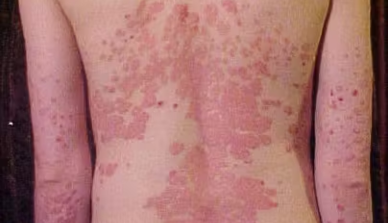 Erythrodermic psoriasis on a person's back