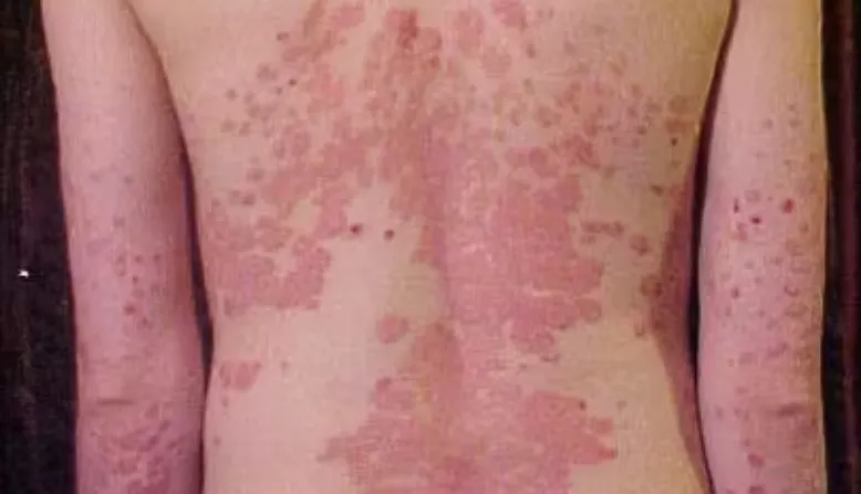Anular Rash Psoriasis Psoriasis on the Back: Symptoms, Causes & Treatment