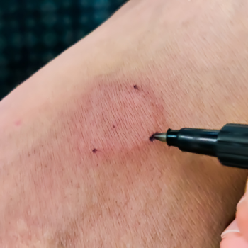 A skin prick test for tuberculosis on an arm being marked with a marker.