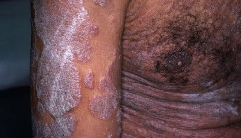 Plaque psoriasis in skin of color.