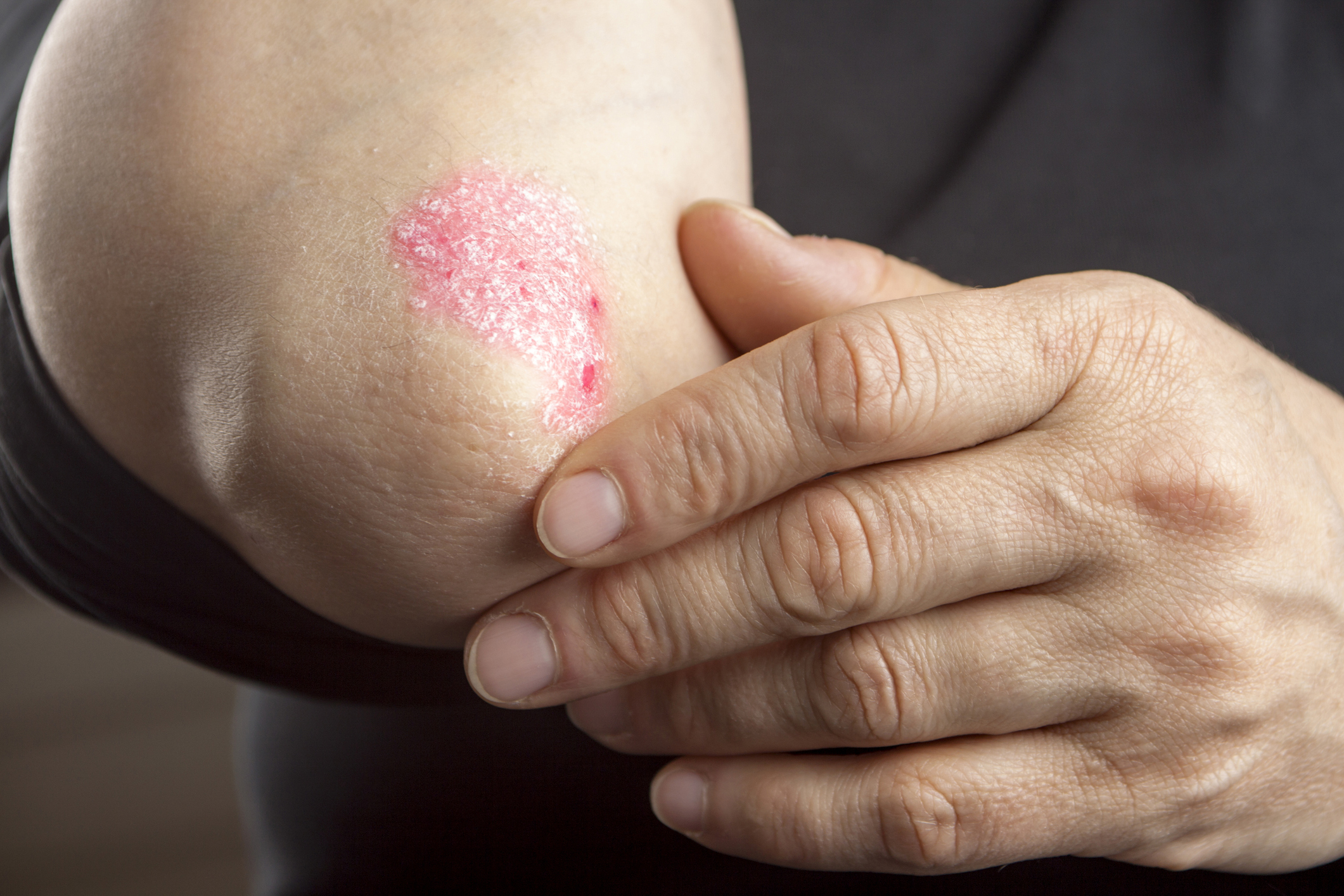 A person touches psoriasis on their elbow.