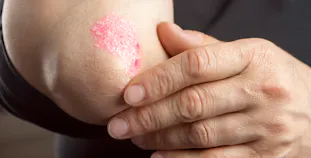 A person touches psoriasis on their elbow.