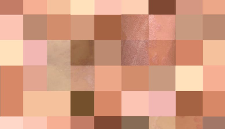 A patchwork of various skin tones with photos of psoriasis on skin of color underlaid.