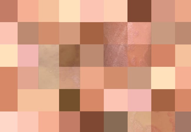 A patchwork of various skin tones with photos of psoriasis on skin of color underlaid.
