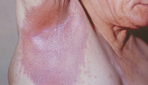 Inverse psoriasis on the armpit, arm, and chest of a white person.