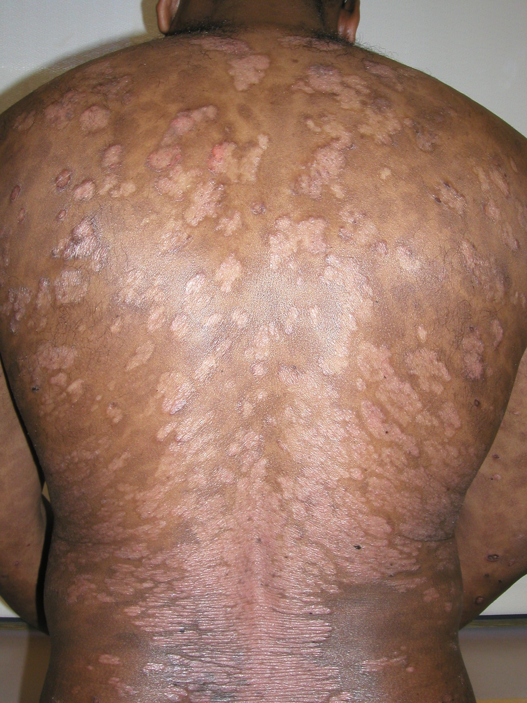 Guttate psoriasis on skin of color