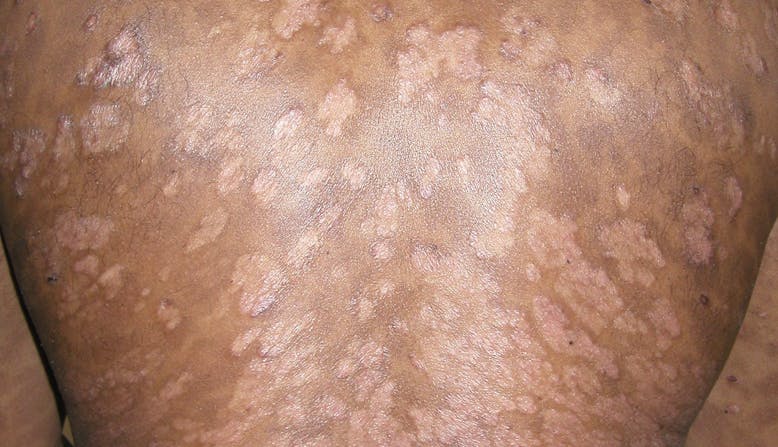 Skin of Color link, Image of a guttate psoriasis on a person's back