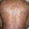 Image of a guttate psoriasis on a person's back