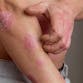 A man with psoriasis plaques scratches his arm.
