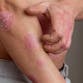 A man with psoriasis plaques scratches his arm.