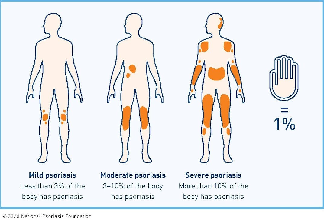 A graphic of 3 bodies and 1% BSA hand print