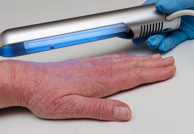 A hand with light skin and visible psoriasis on a surface with a gloved hand holding a phototherapy device above.