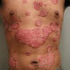 Image of Plaque and Guttate psoriasis on a person's stomach