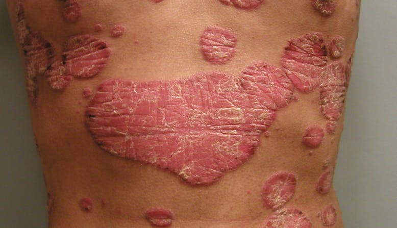 Image of Plaque and Guttate psoriasis on a person's stomach