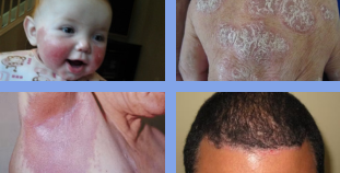 Psoriasis on high impact sites includes the face, hands, skin folds, and scalp.
