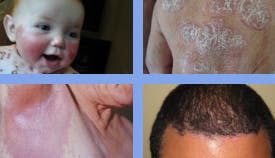 Psoriasis on high impact sites includes the face, hands, skin folds, and scalp.
