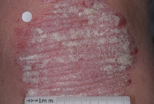 Life with Psoriasis National Psoriasis Foundation