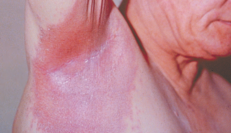 Inverse psoriasis on white skin