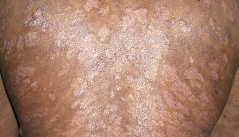 Guttate psoriasis on skin of color