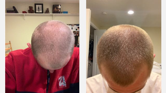 Numankind | Grant's hair regrowth story