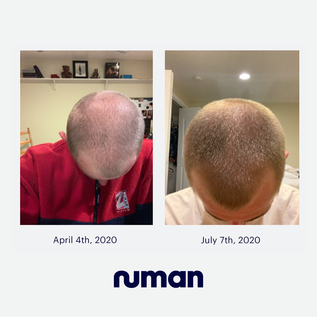 How long does a bald spot take to grow back  Quora