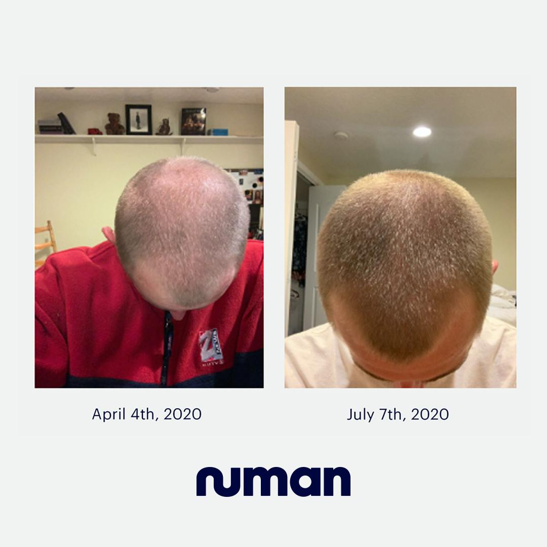 Numankind | Grant's hair regrowth story