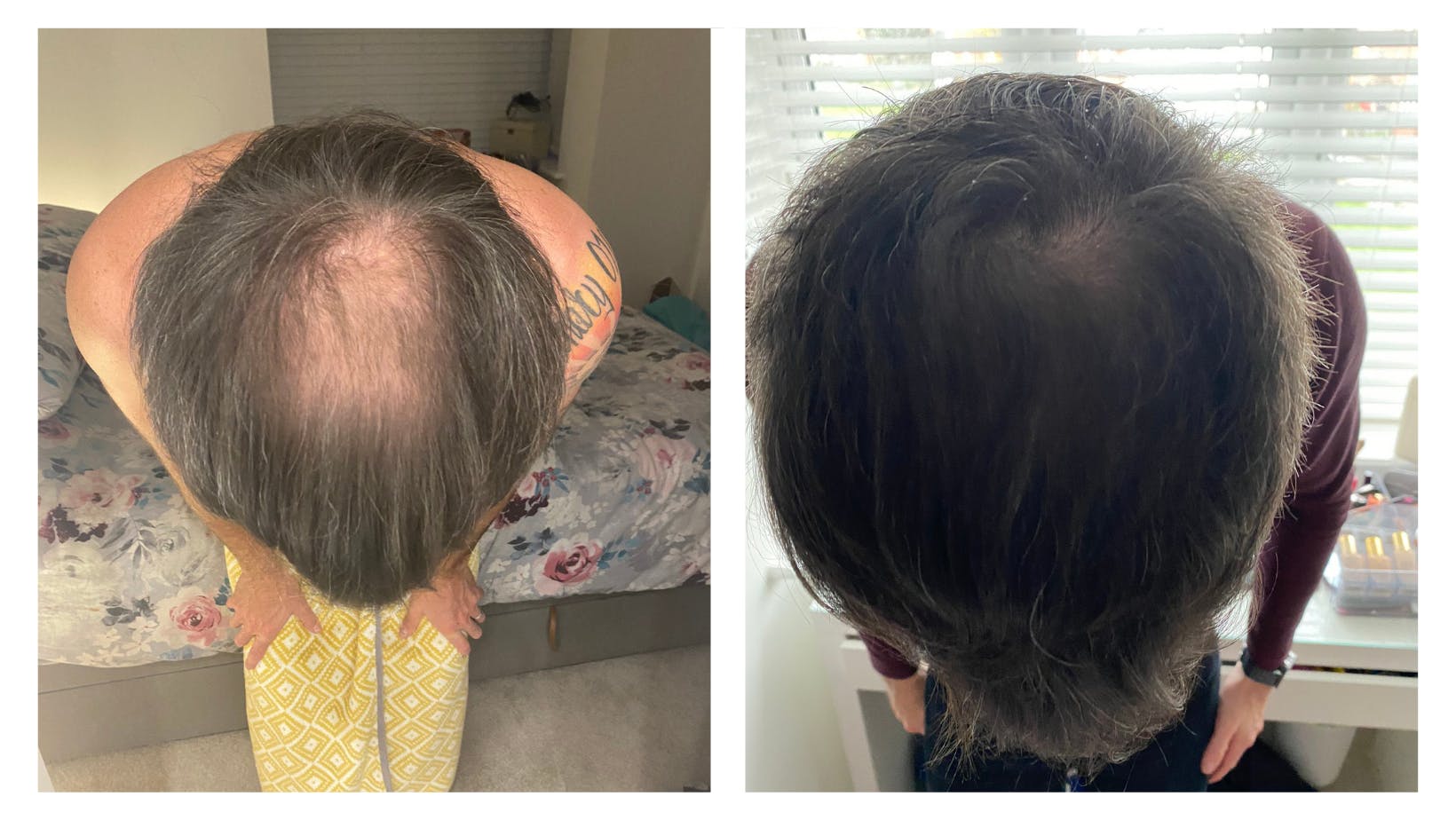 Numankind James’ hair regrowth story