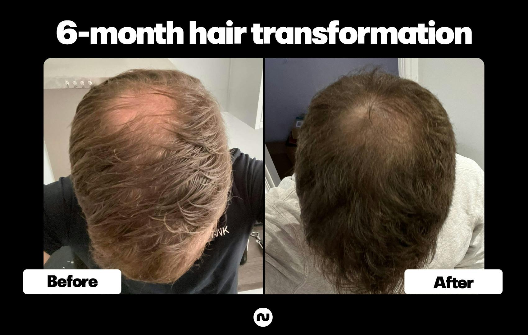 Numankind | Ben's 6-month hair regrowth story