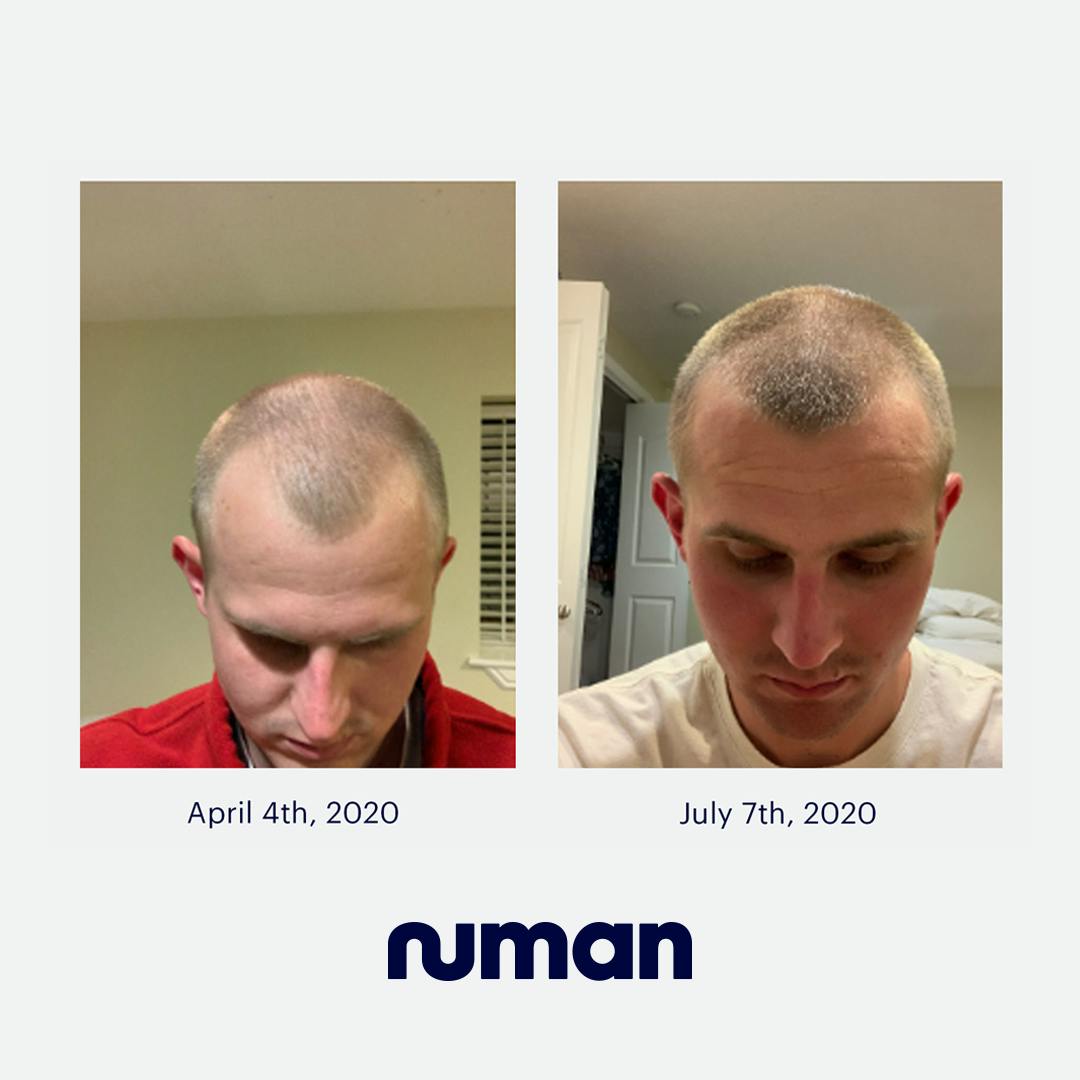 Numankind | Grant's hair regrowth story Numankind | Grant's hair regrowth story