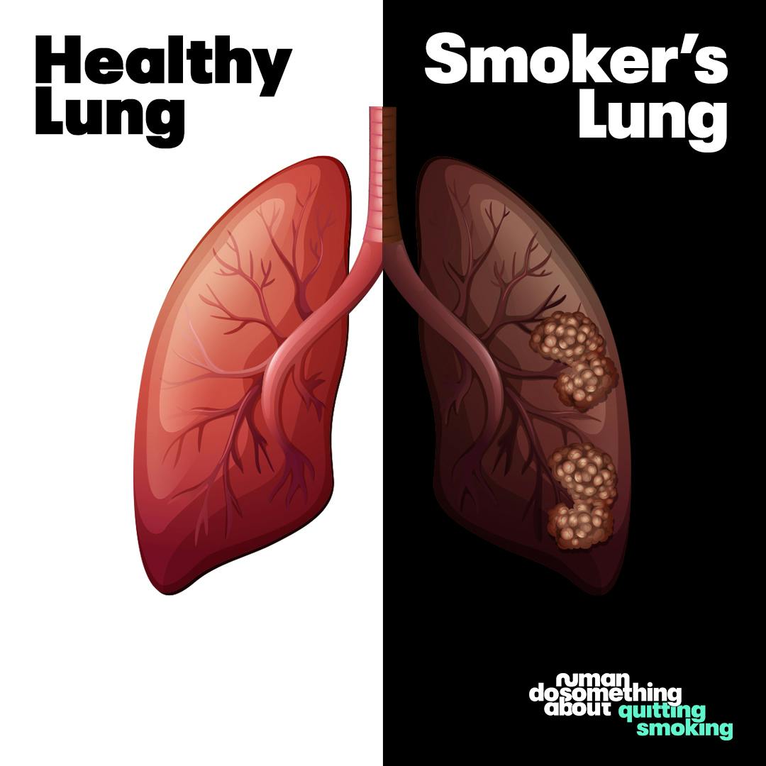 pot smokers lungs vs healthy lungs