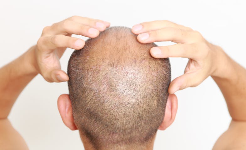 avapro side effects hair loss