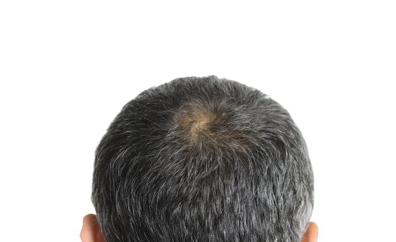 Numankind | The 3 most common types of alopecia