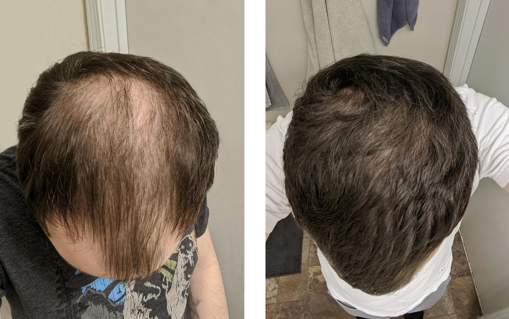 Numankind David's 5month hair regrowth story